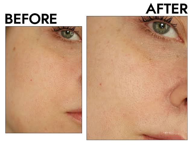 How to Minimise Large Pores: 4 Steps That Work